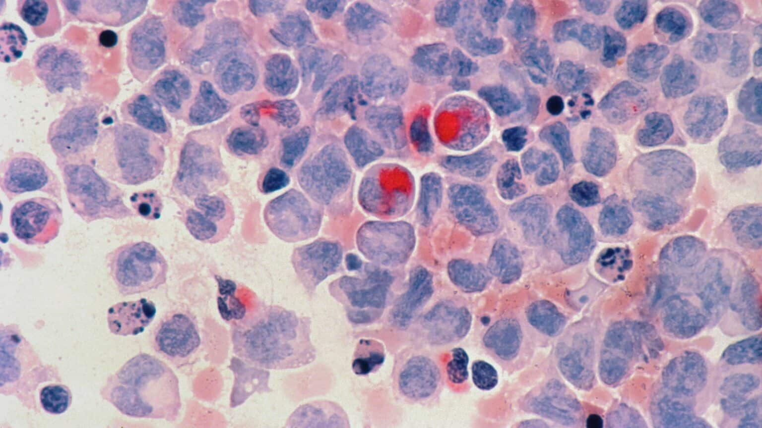 High Vitamin B12 Levels and Cancer Is There a Link? Historic Health